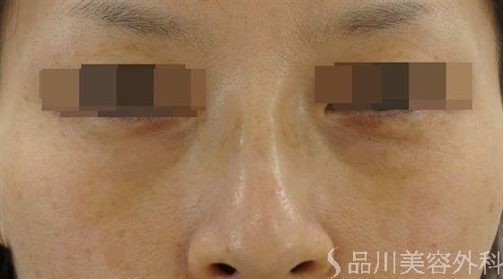 症例NO.40921のBEFORE写真