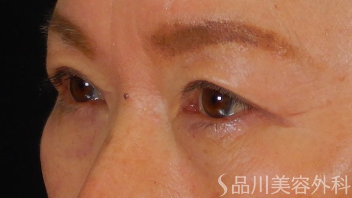 症例NO.69584のAFTER写真