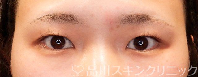 症例NO.70028のBEFORE写真