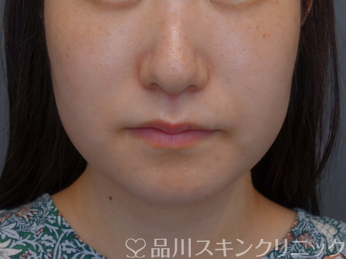 症例NO.75079のAFTER写真
