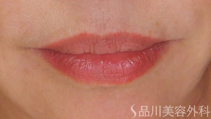 症例NO.69769のBEFORE写真