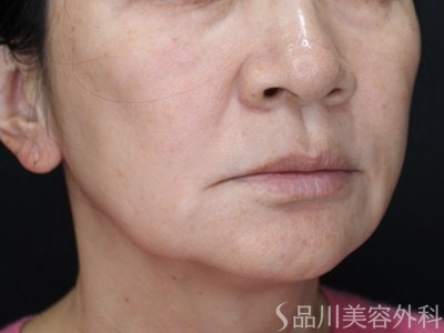 症例NO.69745のBEFORE写真