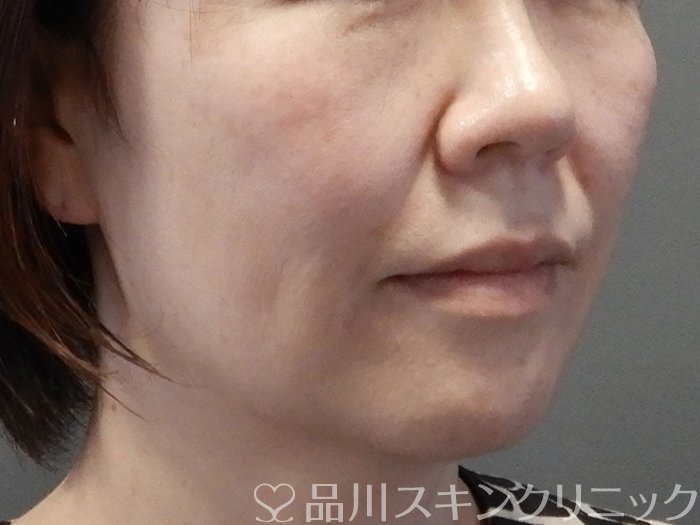 症例NO.63744のBEFORE写真