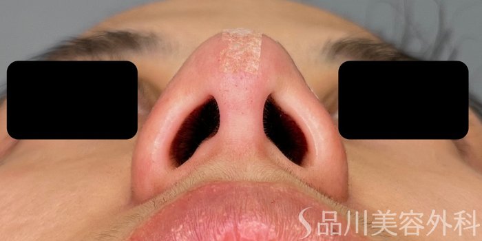 症例NO.72340のAFTER写真