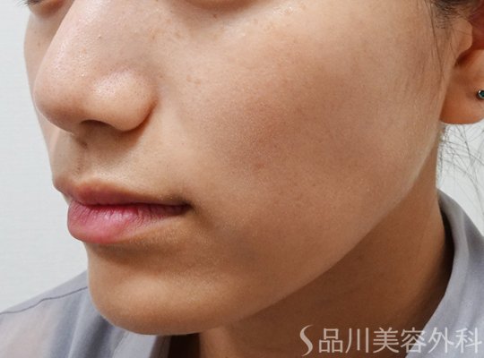 症例NO.68022のAFTER写真