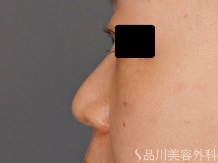 症例NO.63319のBEFORE写真