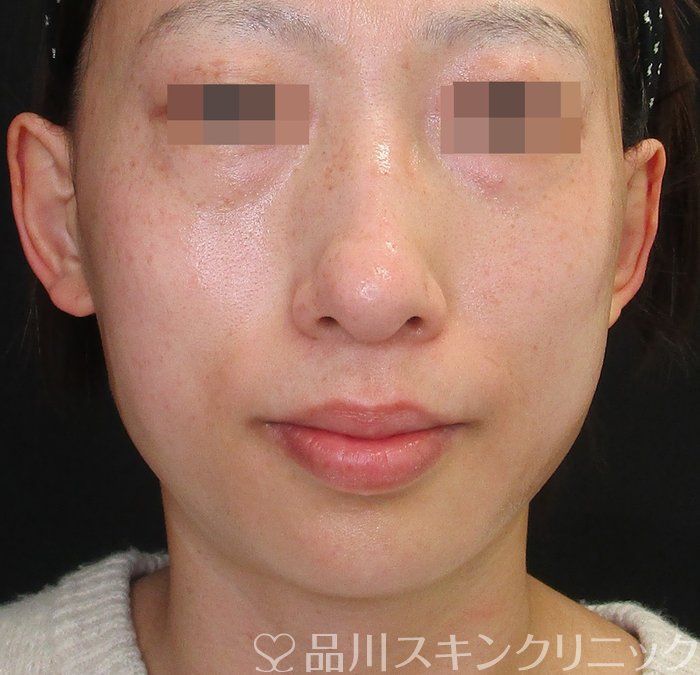 症例NO.74042のAFTER写真