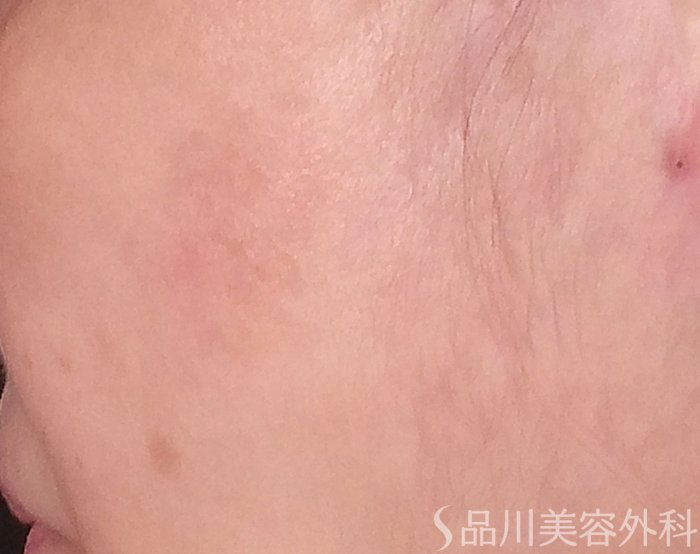 症例NO.70321のAFTER写真