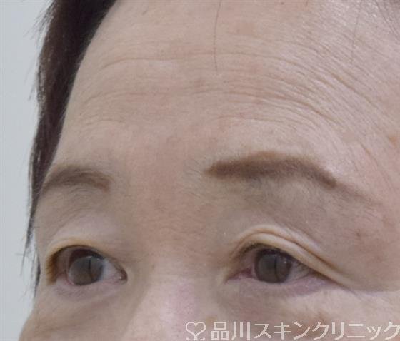症例NO.59200のBEFORE写真