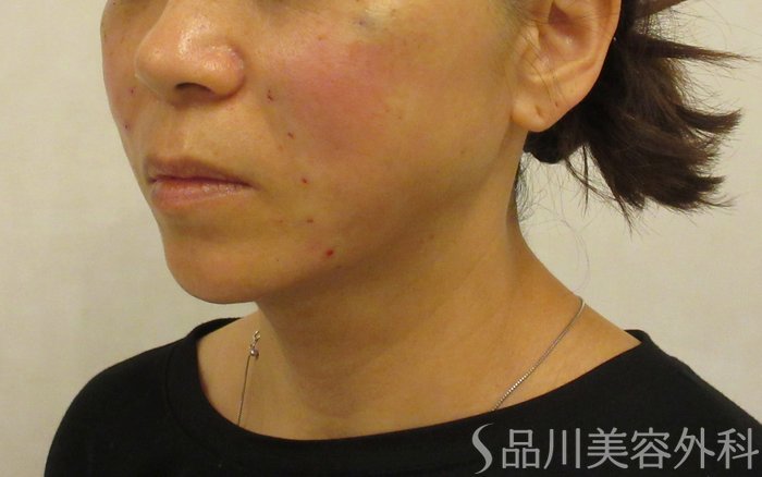 症例NO.72193のAFTER写真