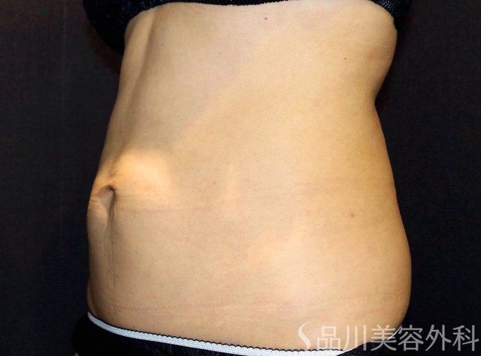 症例NO.72510のAFTER写真