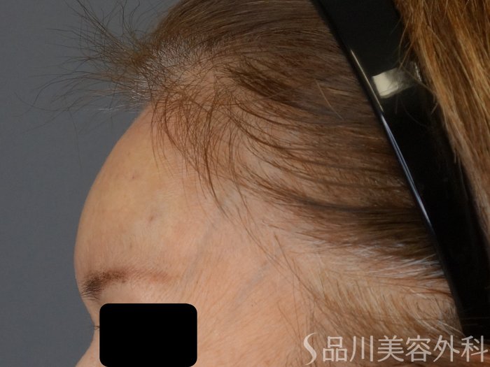 症例NO.74157のAFTER写真