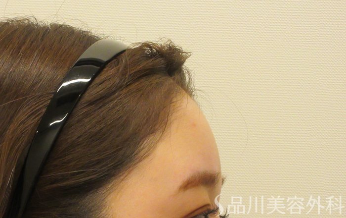 症例NO.70047のBEFORE写真
