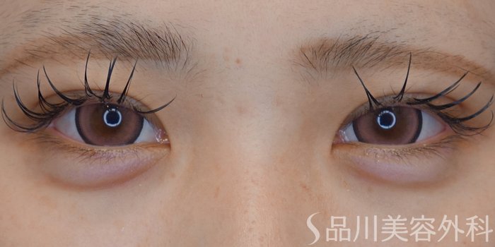 症例NO.69308のAFTER写真