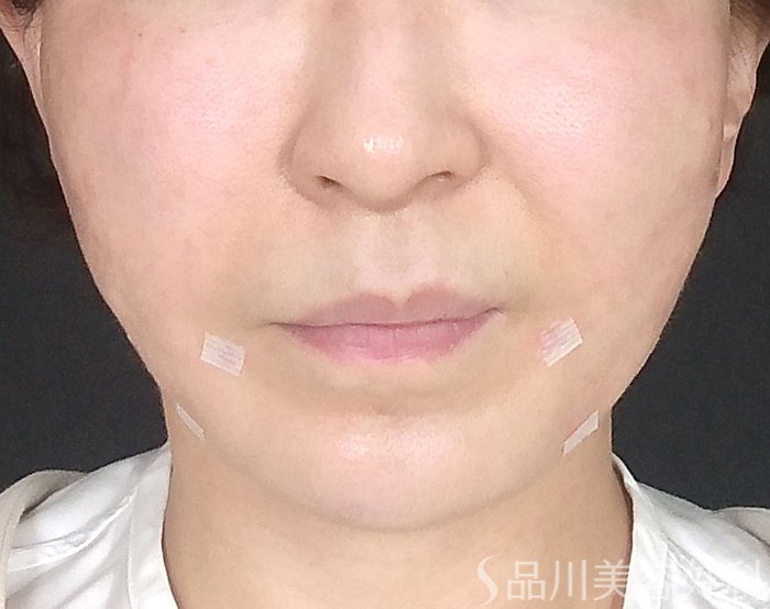 症例NO.65360のAFTER写真