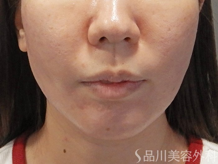 症例NO.71340のAFTER写真