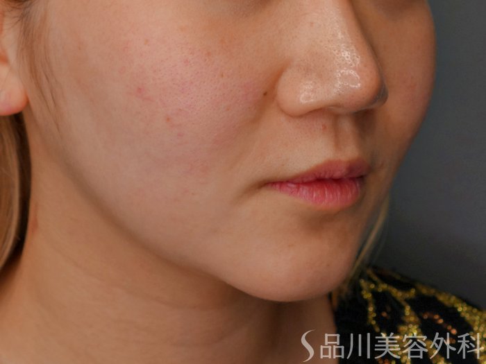 症例NO.73285のBEFORE写真