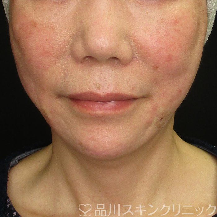 症例NO.69955のAFTER写真