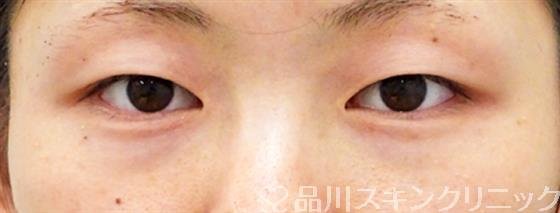 症例NO.48344のBEFORE写真