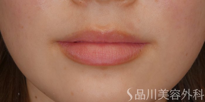 症例NO.69243のBEFORE写真