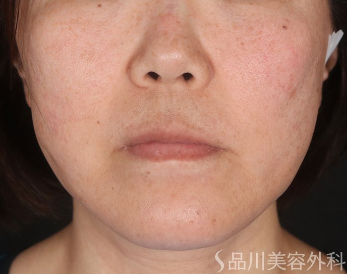 症例NO.72862のAFTER写真