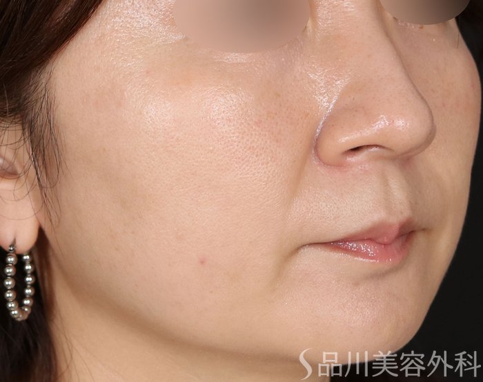 症例NO.70786のBEFORE写真