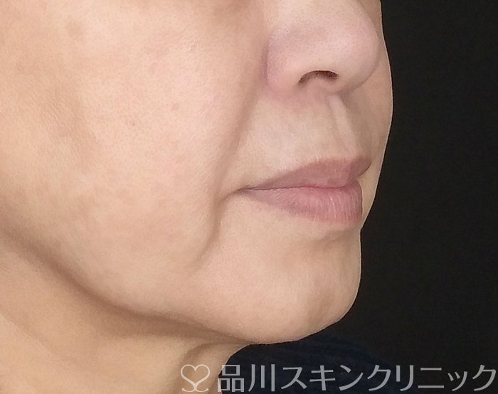 症例NO.68470のBEFORE写真