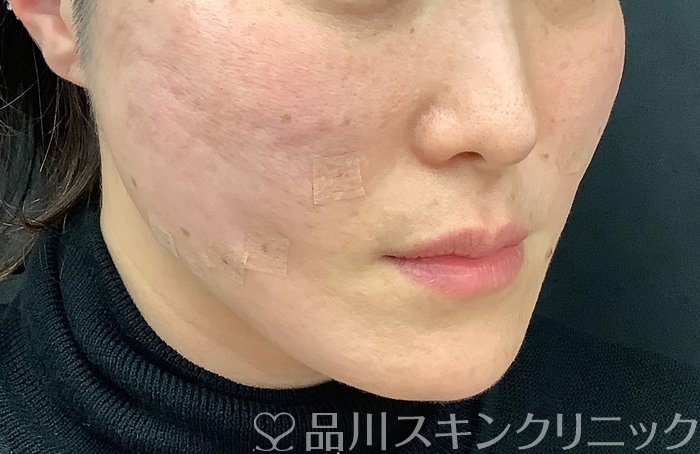 症例NO.69484のAFTER写真