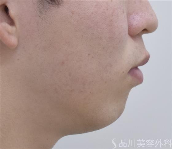 症例NO.47917のBEFORE写真
