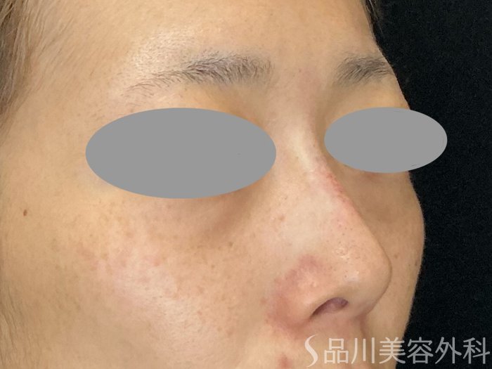 症例NO.73020のAFTER写真