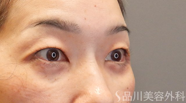 症例NO.75014のAFTER写真