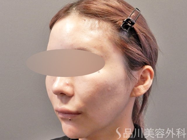 症例NO.67863のAFTER写真
