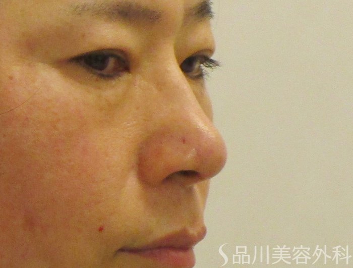 症例NO.65701のAFTER写真