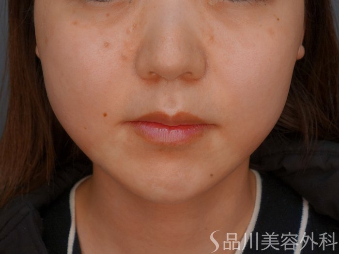 症例NO.75195のAFTER写真