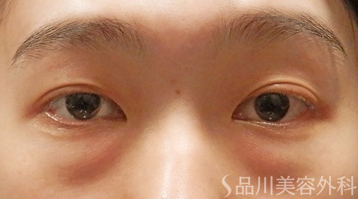症例NO.69304のBEFORE写真