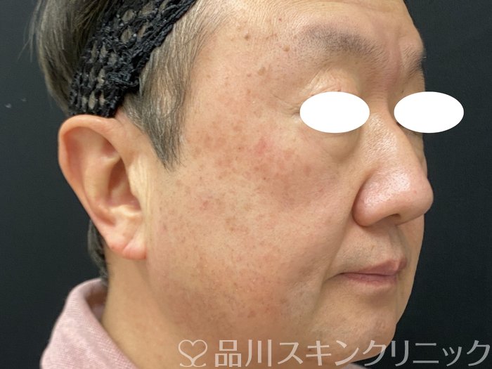 症例NO.74029のAFTER写真
