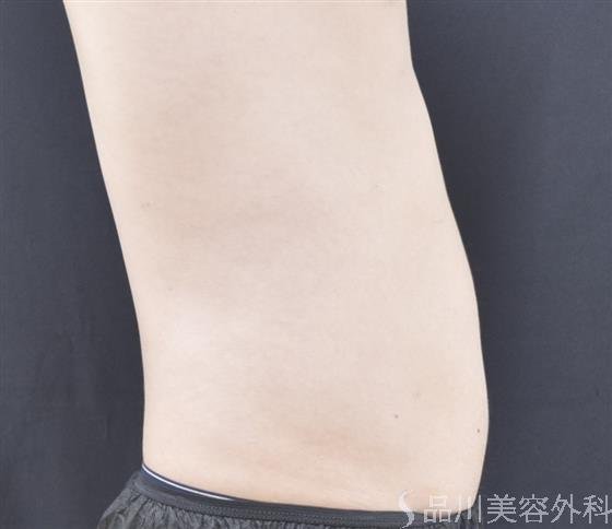 症例NO.44243のAFTER写真