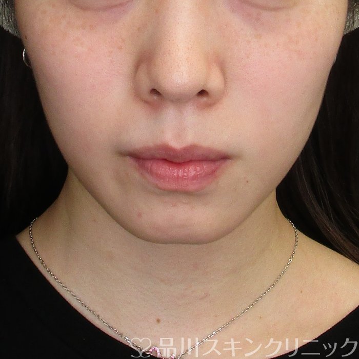 症例NO.74438のBEFORE写真