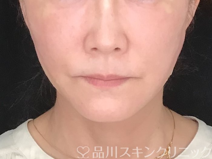 症例NO.64044のAFTER写真