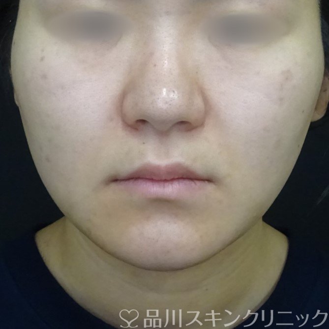 症例NO.69739のAFTER写真
