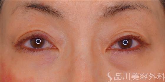 症例NO.55177のBEFORE写真