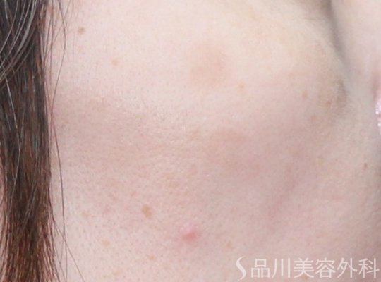 症例NO.74229のAFTER写真