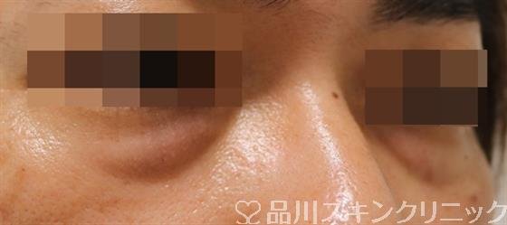 症例NO.41699のBEFORE写真