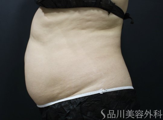 症例NO.75372のBEFORE写真