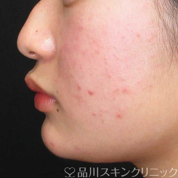 症例NO.72692のBEFORE写真