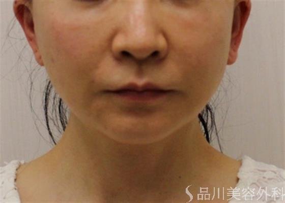 症例NO.25957のBEFORE写真