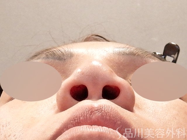 症例NO.67918のBEFORE写真