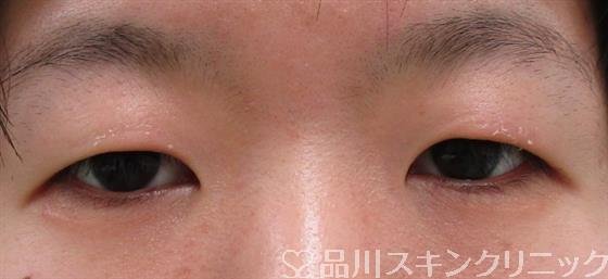症例NO.34397のBEFORE写真