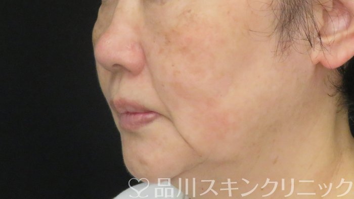 症例NO.72194のAFTER写真