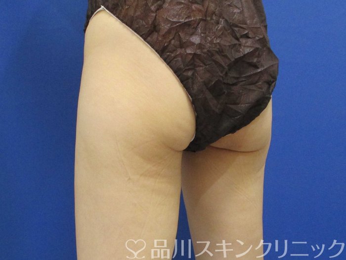 症例NO.71098のBEFORE写真